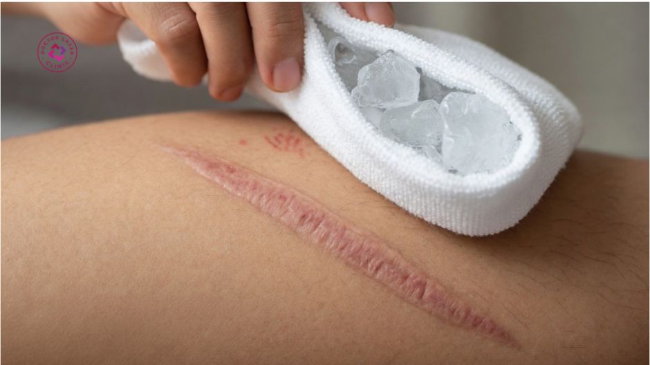 chườm đá giảm ngứa sẹo lồi