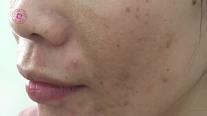 có cần ngưng kem trị nám trước laser pico