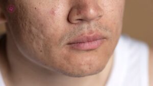 cơ địa sẹo lồi có trị sẹo rỗ được không