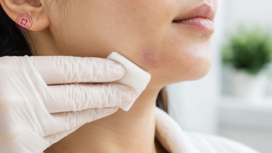 giữ sạch vùng điều trị sẹo lồi trên mặt