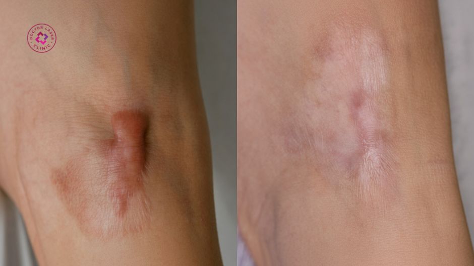 giữ vùng sẹo lồi sạch sẽ khô thoáng trong quá trình điều trị