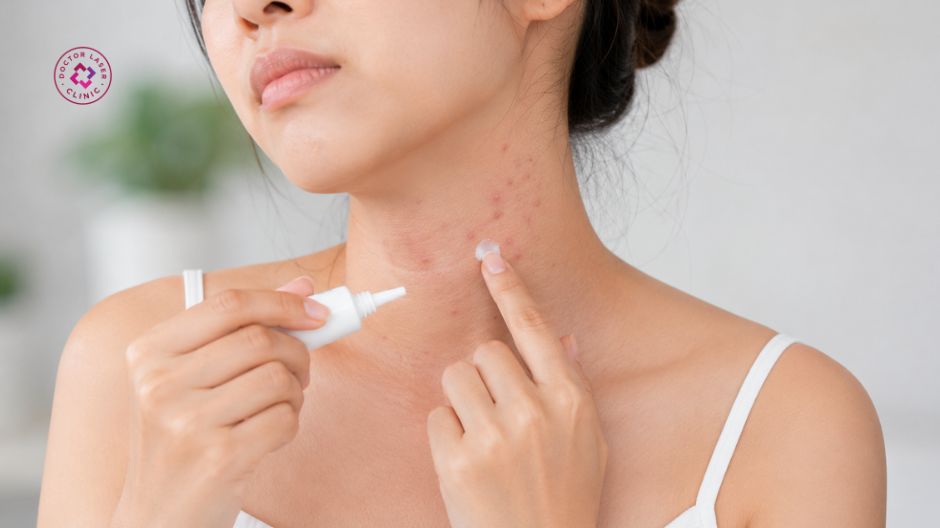 hoạt chất bôi thoa trị mụn trứng cá ở cổ