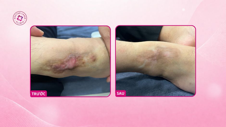 hữu danh điều trị sẹo lồi cổ chân tại doctor laser