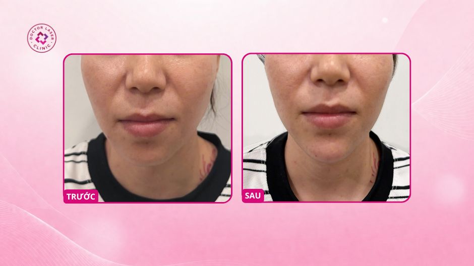 kết quả cải thiện cằm lẹm sau tiêm filler