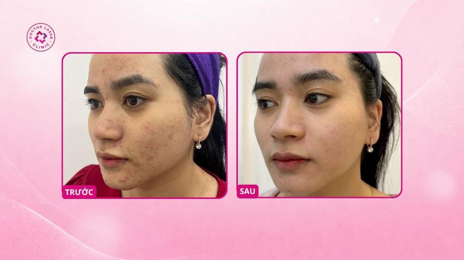 kết quả điều trị mụn tại doctor laser