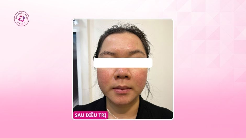 kết quả điều trị sẹo rỗ do mụn viêm