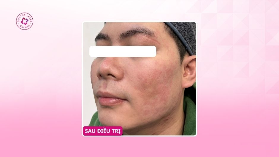 kết quả điều trị sẹo rỗ hai bên má