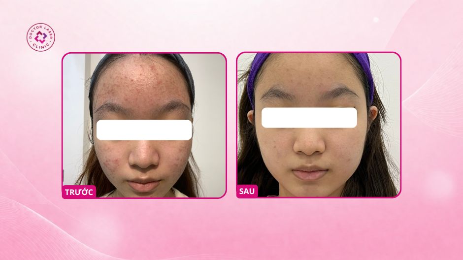 kết quả peel da trị mụn tuổi dậy thì