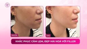 khắc phục cằm lẹm đẹp hài hoà với filler