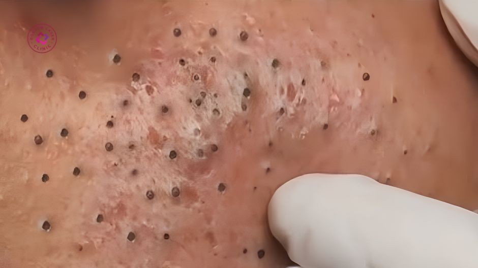 khi nào nên gặp bác sĩ điều trị mụn đầu đen