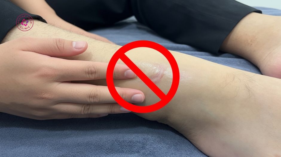 không gãi bóp nặn sẹo lồi sau tiêm
