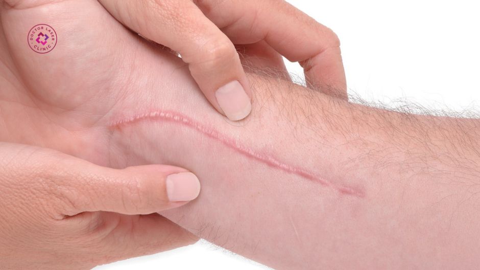 kích thước sẹo lồi ảnh hưởng đến chi phí