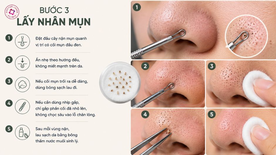 lấy nhân mụn đầu đen ở mũi đúng cách