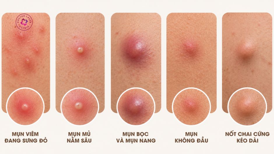 loại mụn không được lấy nhân