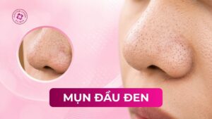 mụn đầu đen