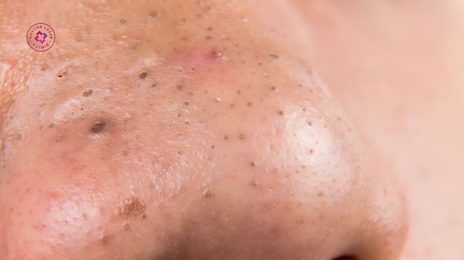 mụn đầu đen có chữa được không