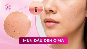 mụn đầu đen ở má