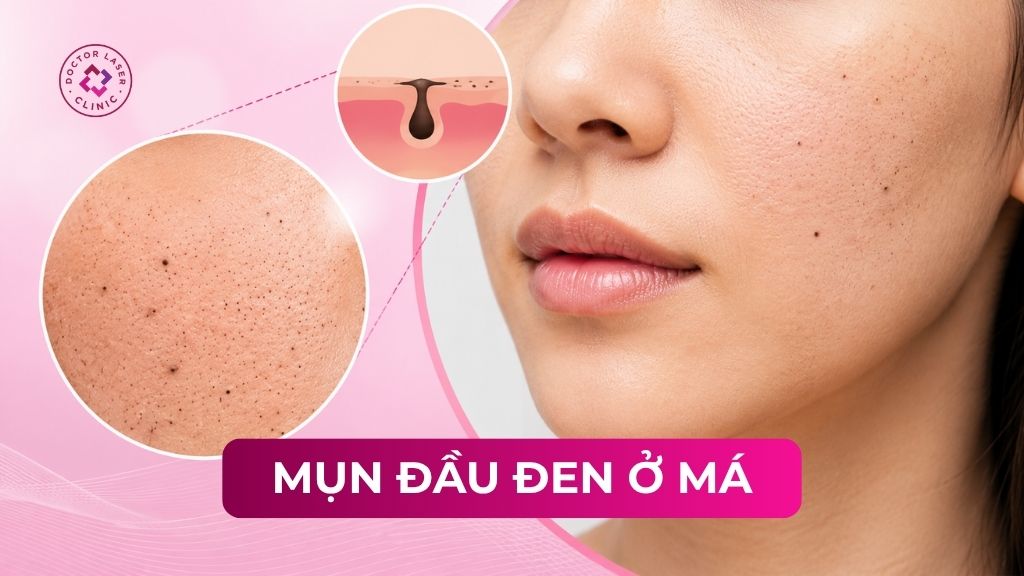 Mụn đầu đen ở má: Nguyên nhân, cách điều trị và phòng ngừa