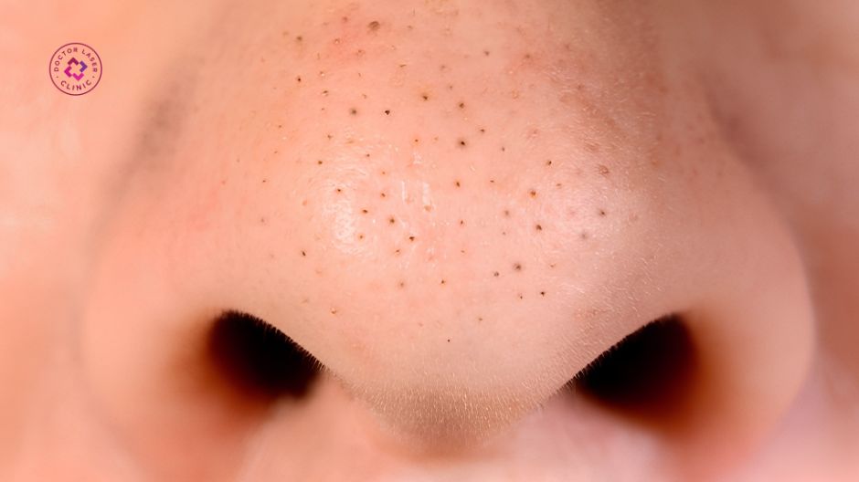 mụn đầu đen ở mũi có trị hết được không