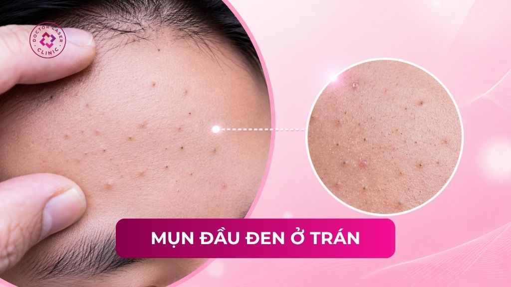 Cách trị mụn đầu đen ở trán hiệu quả theo tiêu chuẩn y khoa