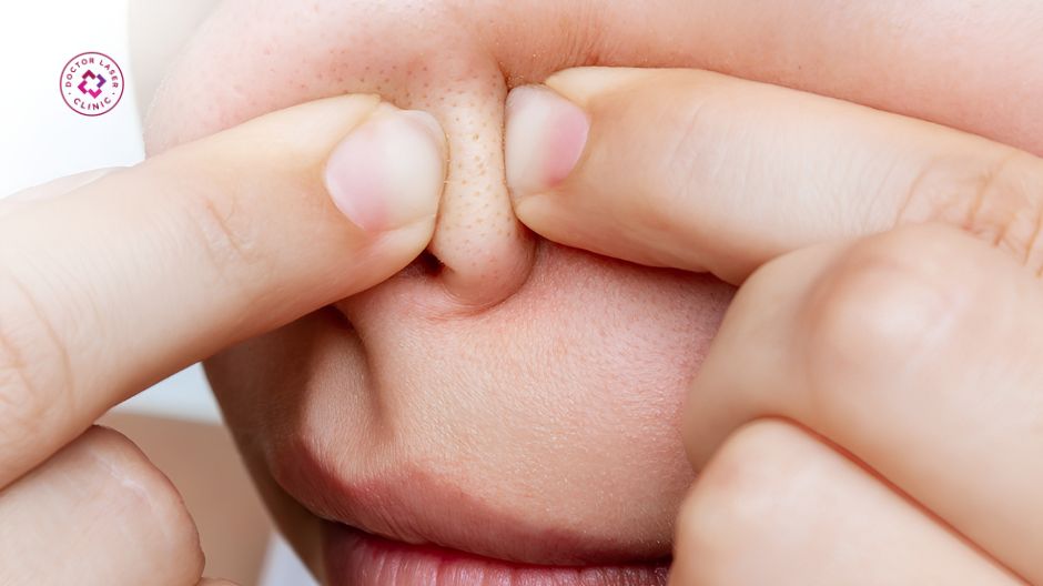 mụn đầu đen tuổi dậy thì có tự hết không