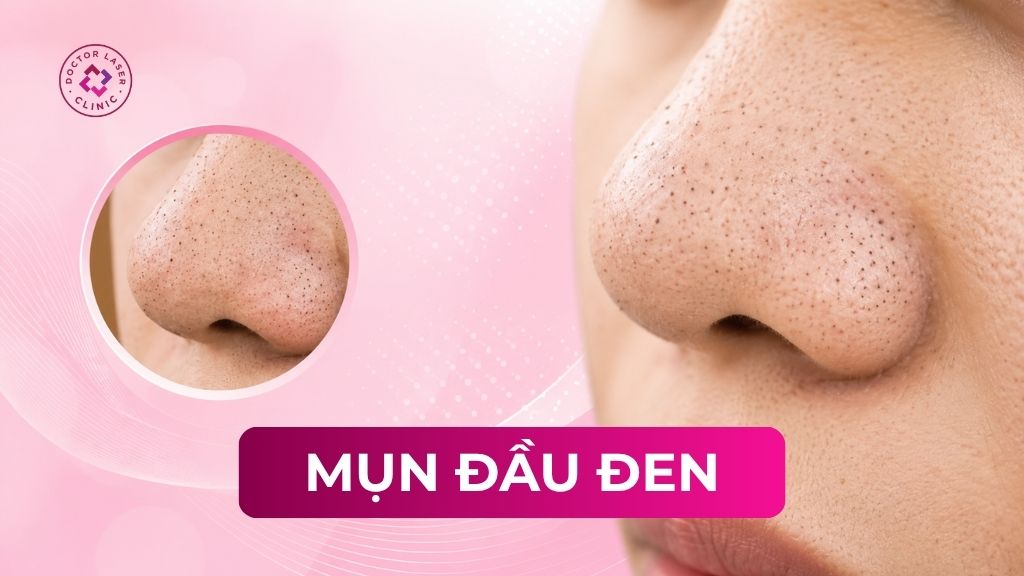 Mụn đầu đen trên mặt: Nguyên nhân, dấu hiệu và một số lưu ý
