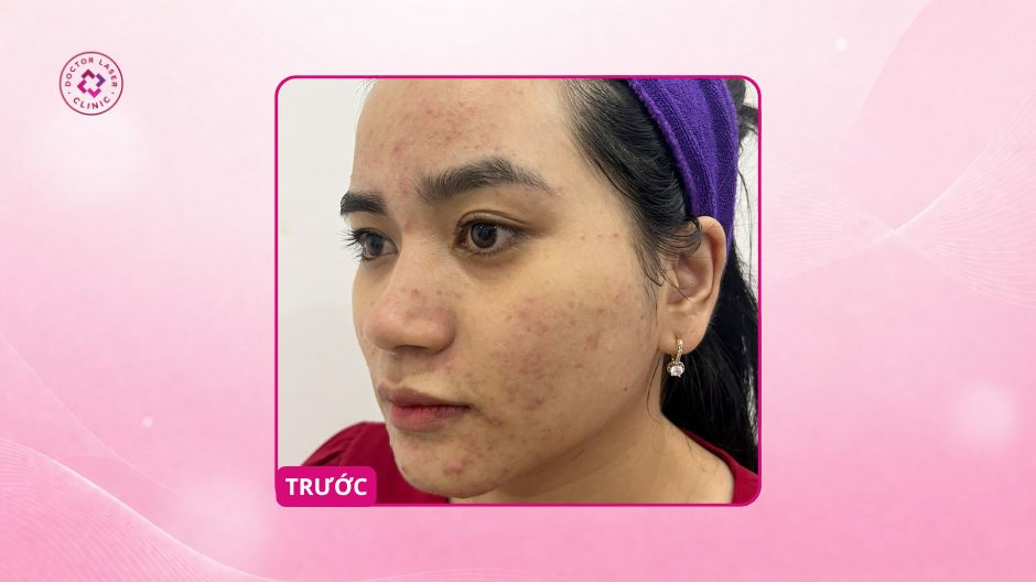 mụn viêm trước điều trị tại doctor laser
