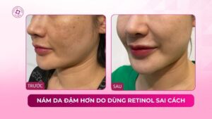 nám da đậm hơn do dùng retinol sai cách