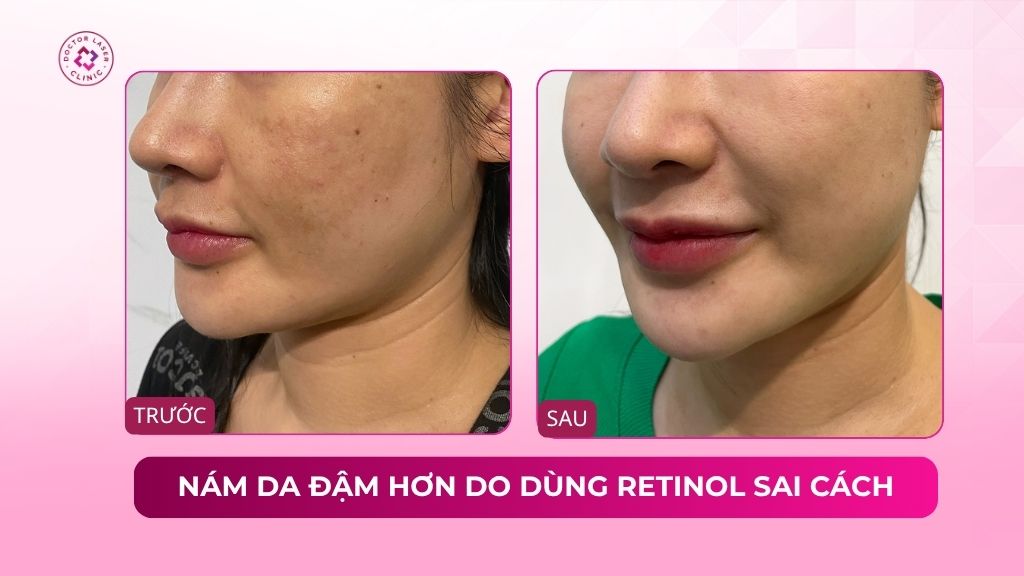 nám da đậm hơn do dùng retinol sai cách