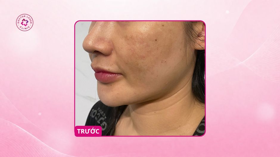 nám da do dùng retinol sai cách trước khi điều trị
