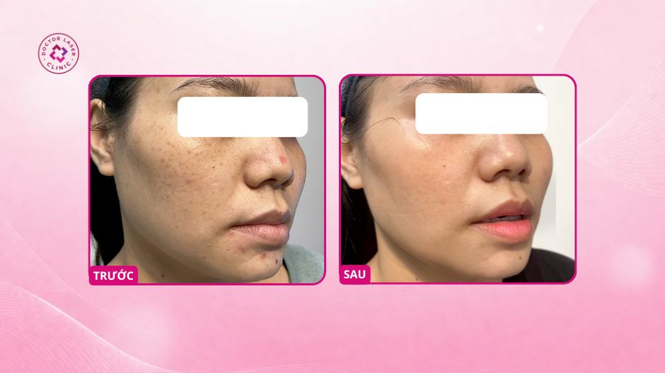 nám hai bên má sau điều trị