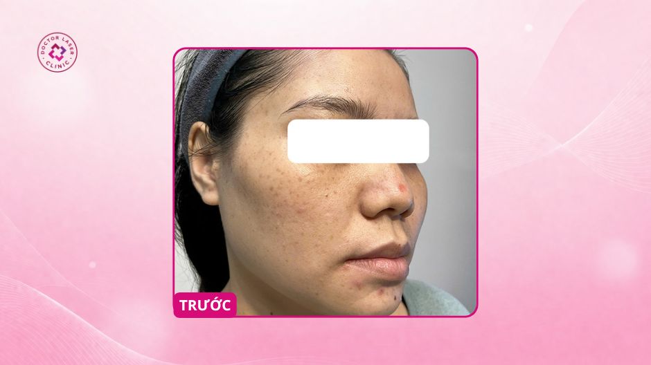 nám hai bên má trước điều trị