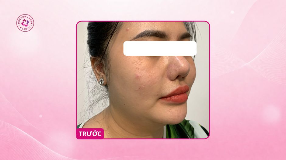 nám hori trước điều trị laser pico