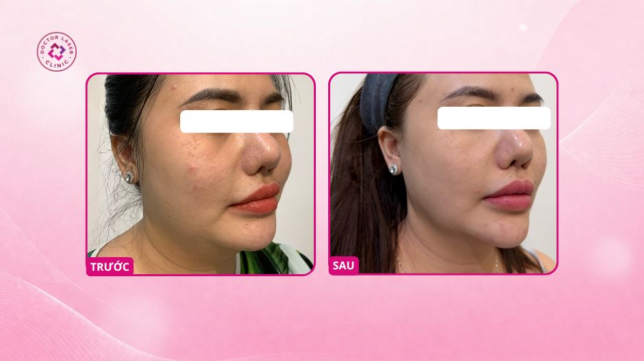 nám hori trước sau điều trị laser pico