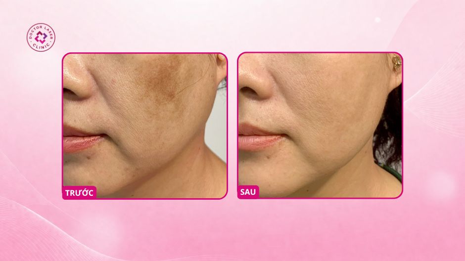 nám má sau phi kim cải thiện sau điều trị