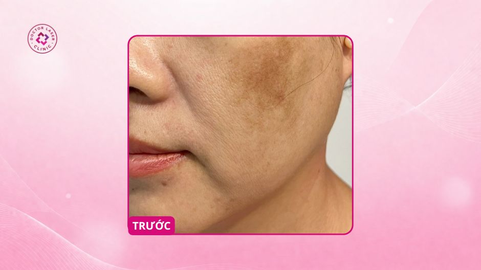 nám má sau phi kim trước điều trị