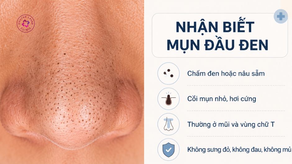 nhận diện mụn đầu đen ở mũi