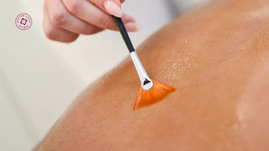 peel da body làm mờ thâm sau mụn