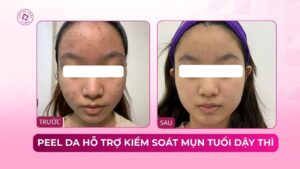peel da hỗ trợ kiểm soát mụn tuổi dậy thì