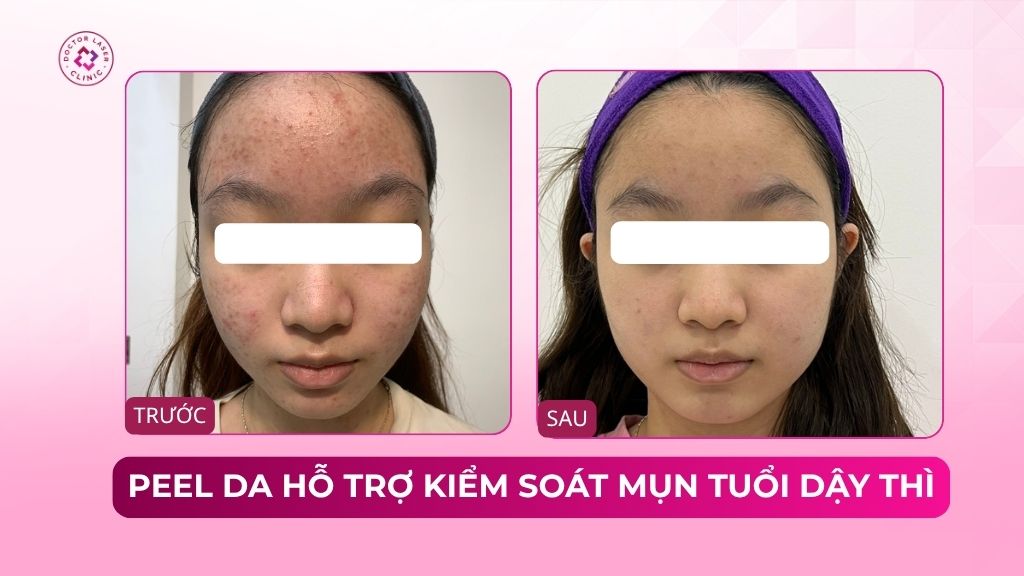 peel da hỗ trợ kiểm soát mụn tuổi dậy thì