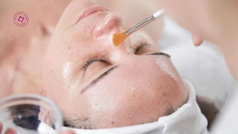 peel da hóa học trị mụn trứng cá quanh miệng