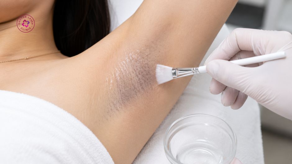 peel da hóa học trị thâm nách