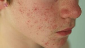 peel da ở spa và bác sĩ khác nhau không