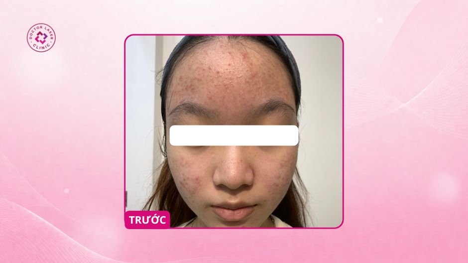 peel da trị mụn tuổi dậy thì trước điều trị