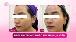 peel da trong phác đồ trị mụn viêm