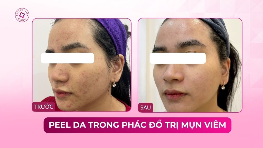 peel da trong phác đồ trị mụn viêm