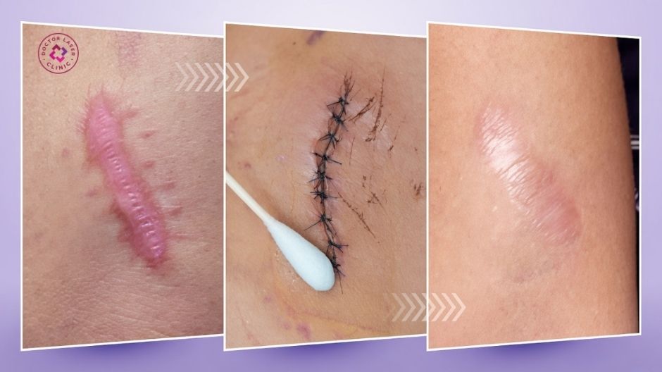 phẫu thuật cắt bỏ sẹo lồi trên má