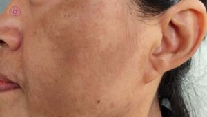prp trị nám có phù hợp với nám chân sâu không