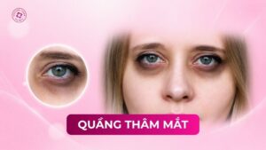 quầng thâm mắt