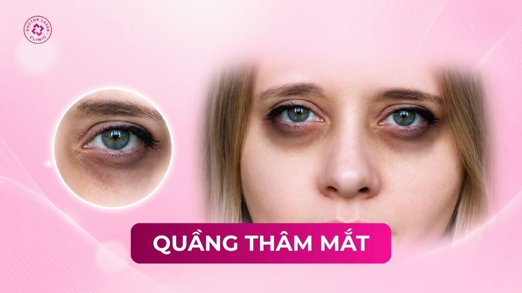 Quầng thâm mắt là do đâu? Các phương pháp điều trị và cách ngăn ngừa